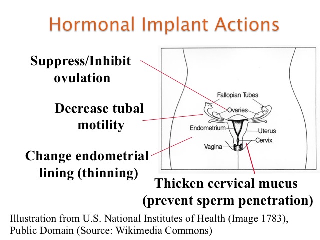 image of implanon rod